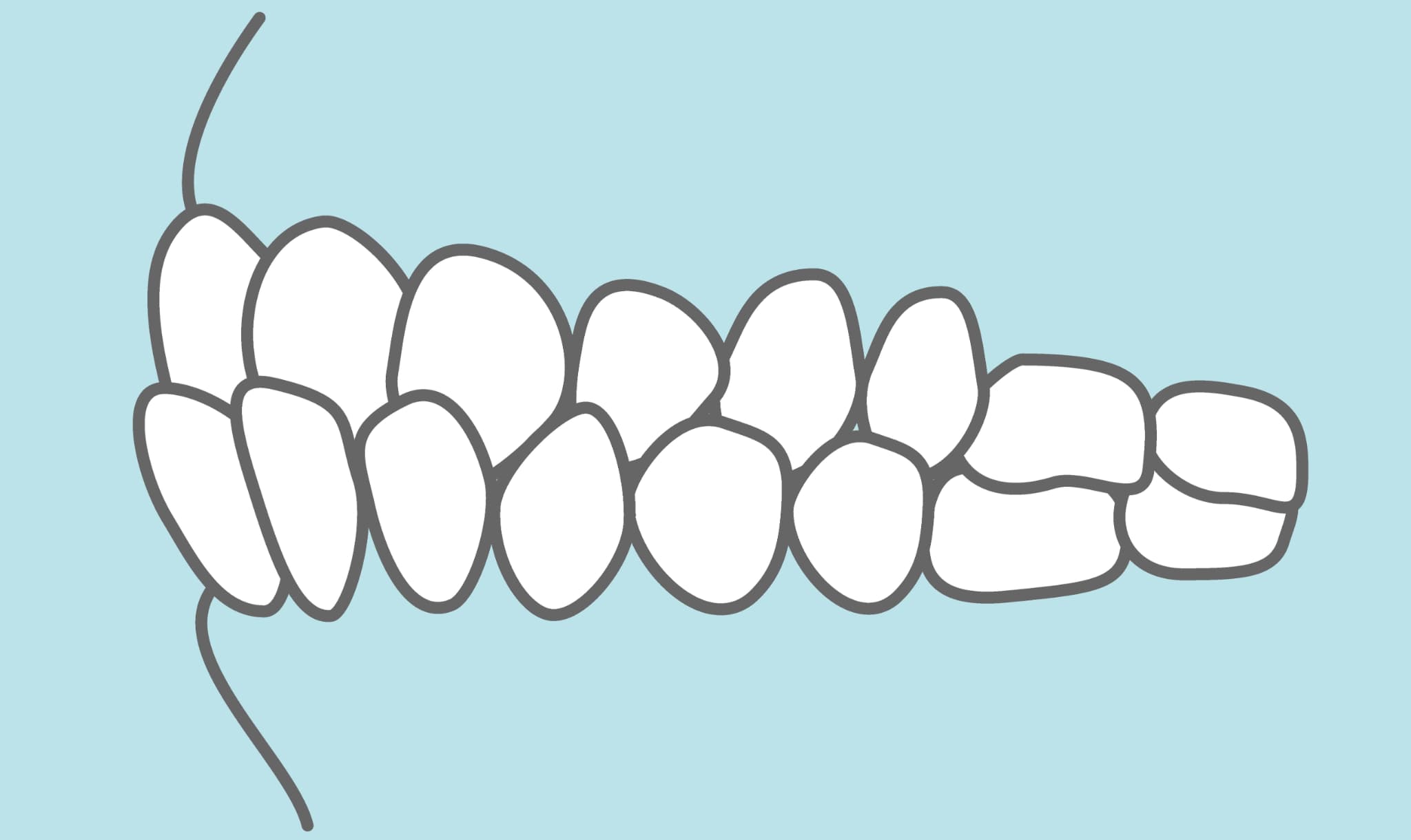 受け口の歯並び